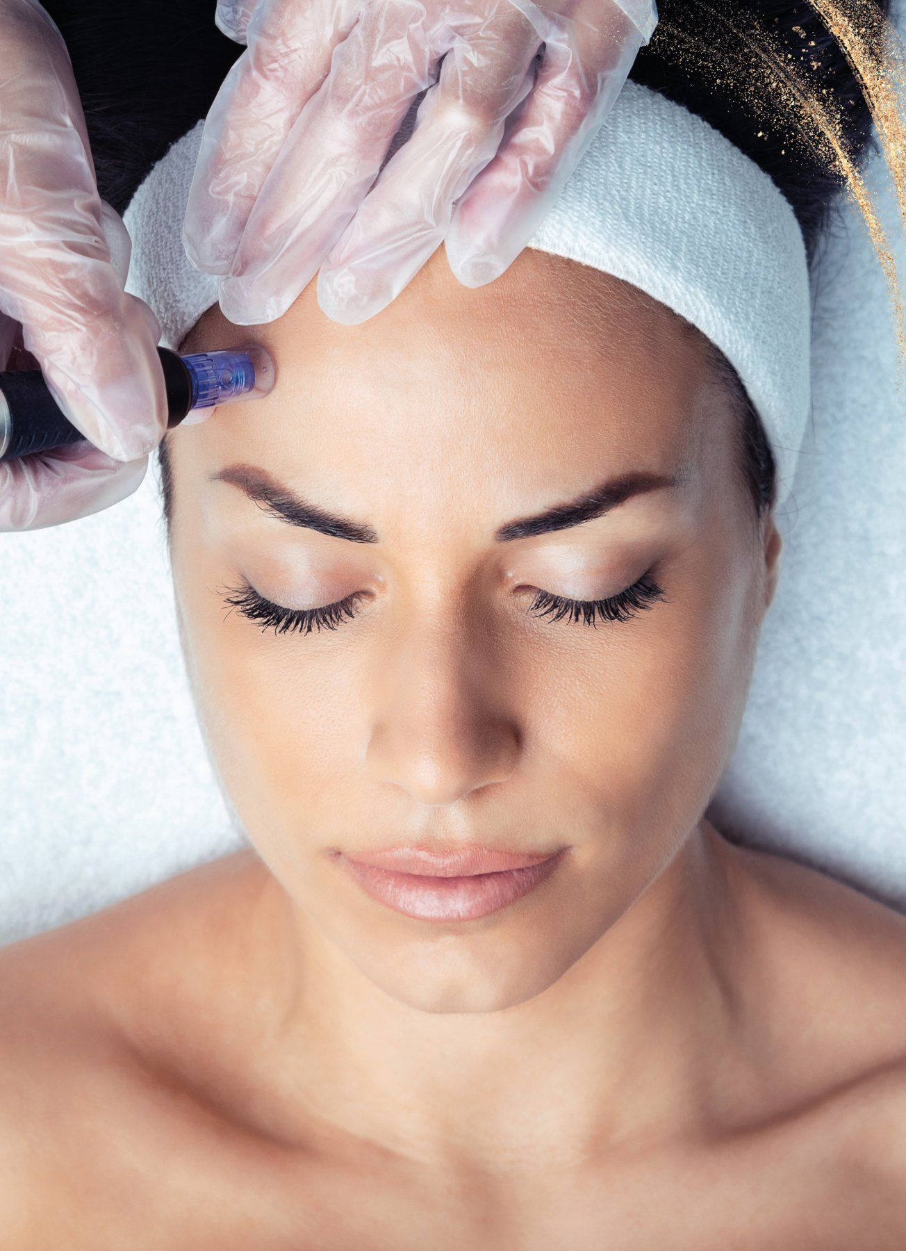 Microneedling-Behandlung im Gesicht bei go´smetics in München – Oktober-Angebot: komplettes Gesicht für 149 €